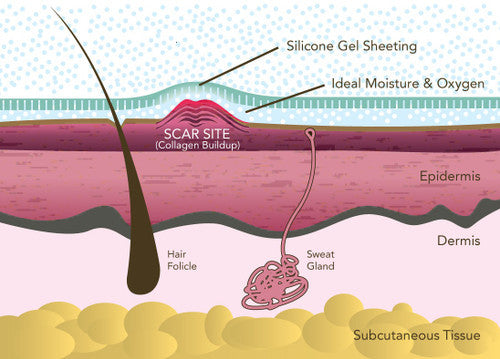 Epi-Derm Clear Gel Sheeting - C-Section Strips - 1 Strip