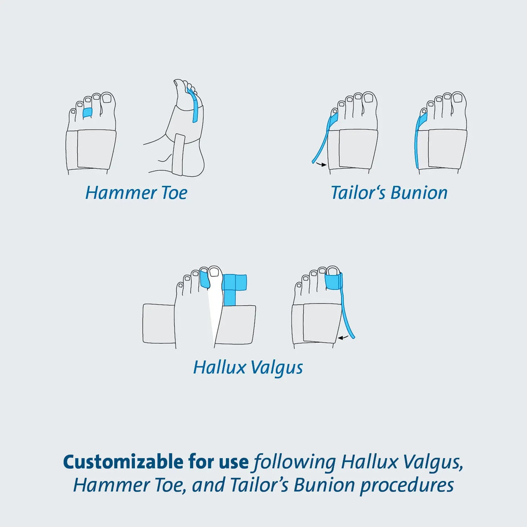 Customizable foot support for Hallux Valgus, Hammer Toe & Tailor’s Bunion recovery