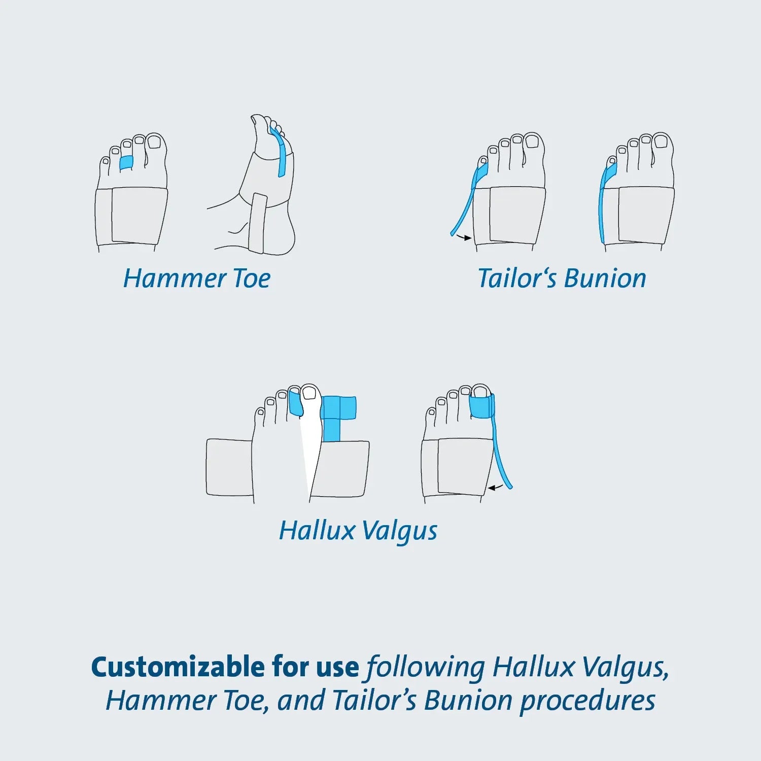 Customizable foot support for Hallux Valgus, Hammer Toe & Tailor’s Bunion recovery