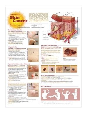 Bodyline Understanding Skin Cancer Chart