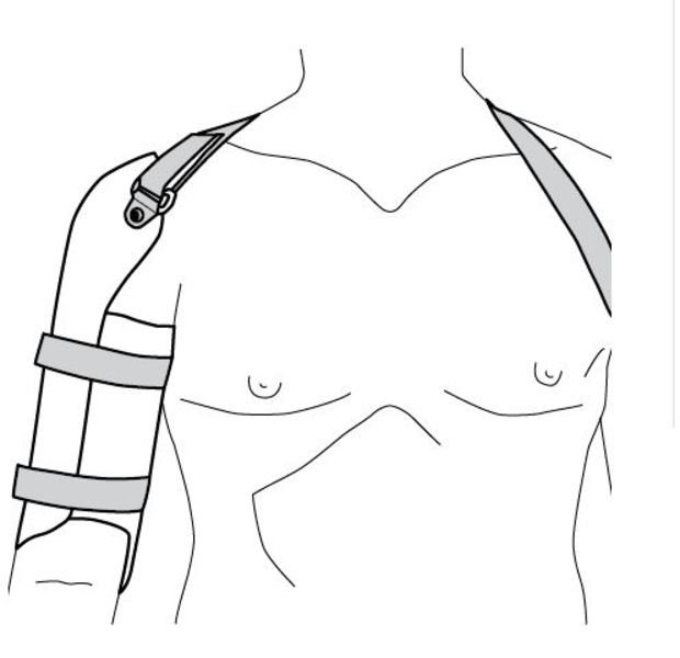 Ossur Humeral Cast Brace for upper arm fracture support