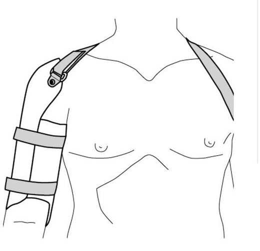 Ossur Humeral Cast Brace for upper arm fracture support